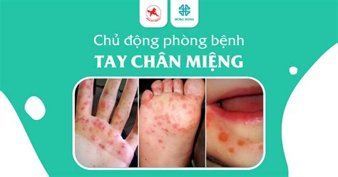 Chủ động Phòng Tránh Bệnh Tay Chân Miệng Cho Trẻ Mùa Dịch Hong Hung