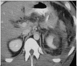 Learningradiology Acute Abdominal Emergencies