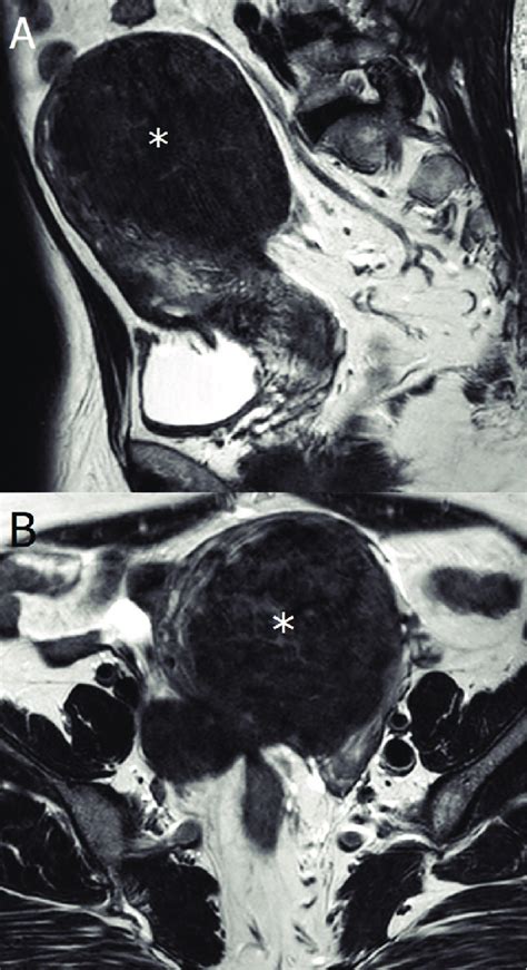 MRI Showed A Large Intramural To Subserous Part Of Myoma Uteri At