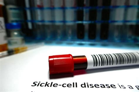 Sickle Cell Disease Treatment Rare Disease Advisor