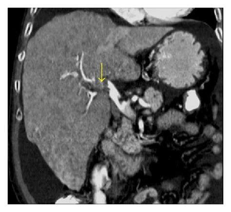 Portal Vein Thrombosis In A Patient With Hcc Complicating Hepatic