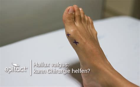 Pin Auf Hallux Valgus EPITACT