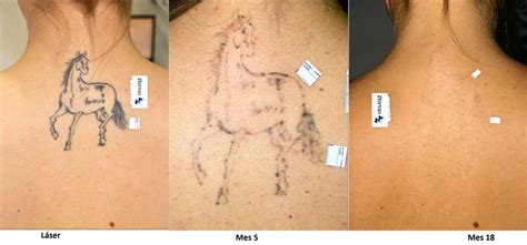 Descubrir 84 Imagem Cuanto Cuesta Eliminar Un Tatuaje Con Laser