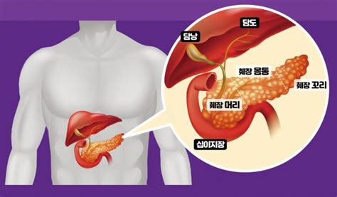 조기발견 시 높아지는 췌장암 생존율 검사는 어떻게