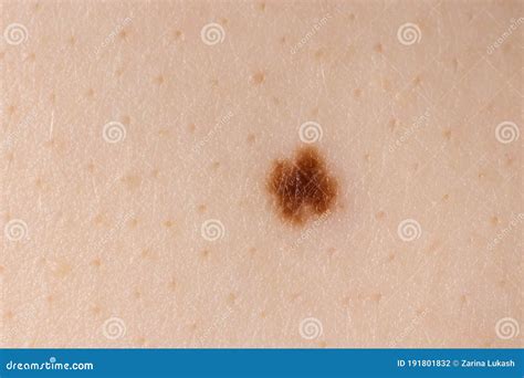 Mole Birthmark Nevus Macro Photo On Human Skin Close Up Stock Photo