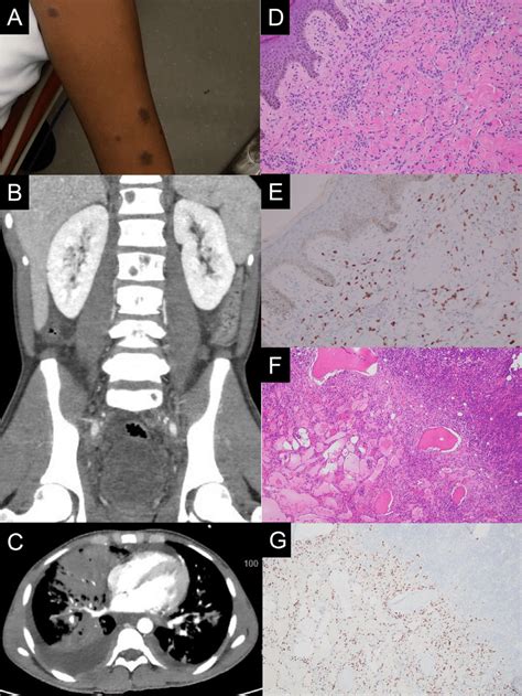 Gross And Microscopic Manifestations Of Kaposi Sarcoma Ks A