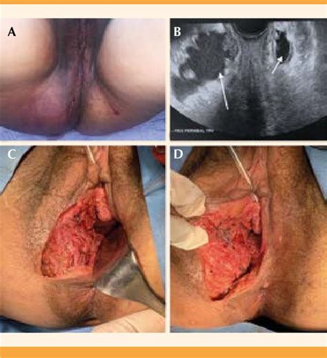 A Exploración física hematoma en la región perineal y glútea derecha