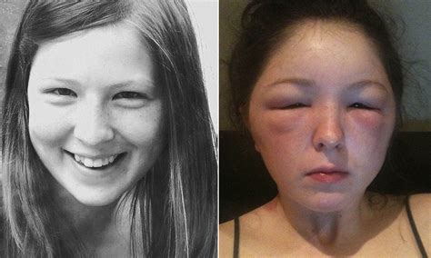 Another Teenager Left With Horribly Swollen Face After Allergic Reaction To Hair Dye Daily