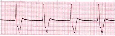 Accelerated Idioventricular Rhythm - EKG Lesson #315