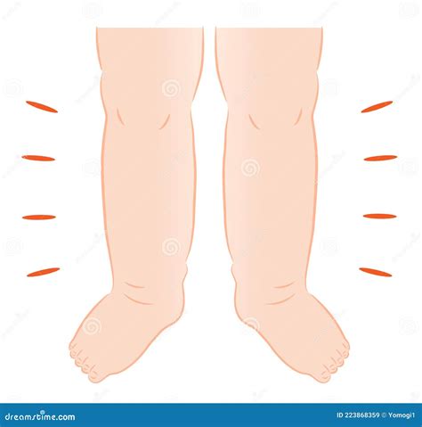 Swelling Of The Feet Swollen Ankles And Feet Vector Illustration