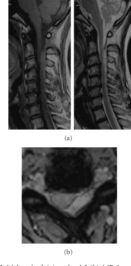 Figure 1 From Hemiparesis Caused By Cervical Spontaneous Spinal