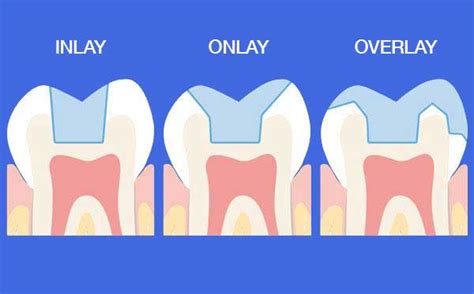 Porcelain Inlays and Onlays, Periodontist Los Angeles | Dr. Bijan Afar