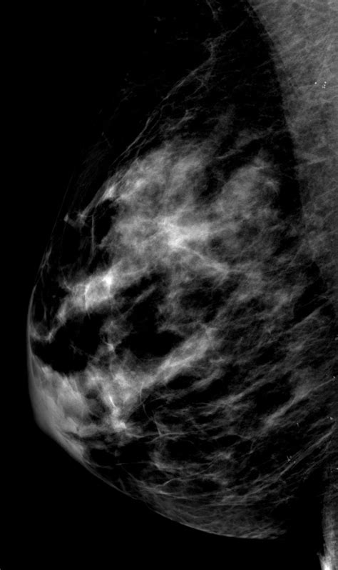 Segmental Breast Calcifications AJR