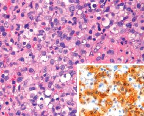 Systemic Anaplastic Large T Cell Lymphoma Dense Diffuse Infiltrate In