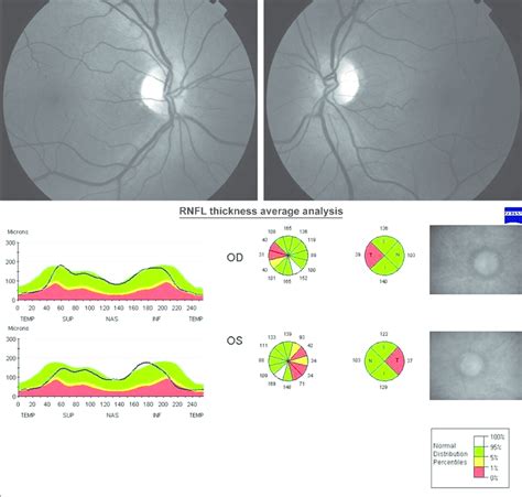 Case 2 Stratus Optical Coherence Tomography Showing Retinal Nerve Fi