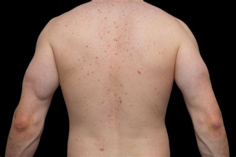 Back Acne Causes Prevention And Treatment