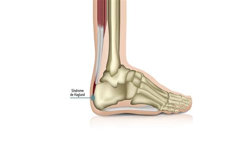 Doença de haglund tudo o que você precisa saber sobre o esporão