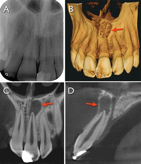 Uso De La Tomograf A Volum Trica De Haz C Nico En Endodoncia