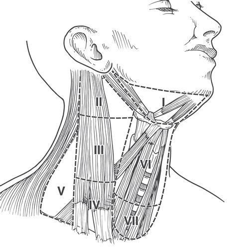 Central Neck Dissection Updates On Indications And Surgical Technique