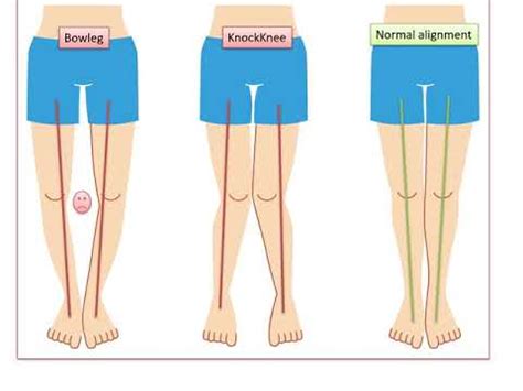 Varus Deformity Of Knee Treatment Doctorvisit