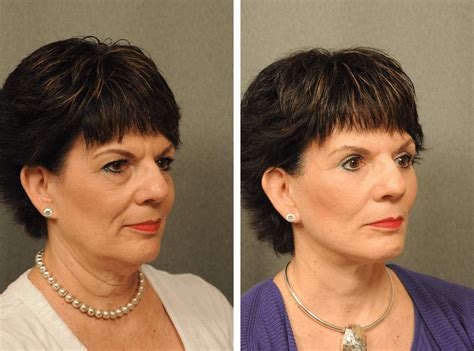 Pin On Changes Rapid Facelift