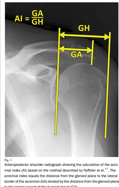 Figure 1 From Association Between Acromial Index And Outcomes Following Arthroscopic Repair Of