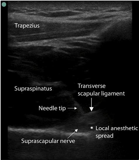 Suprascapular Nerve Block Ultrasound