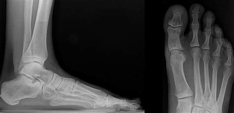 Hallux Limitus And Hallux Rigidus Dr Hobeychi Podiatrist