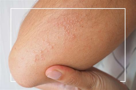 Heat Rash Symptoms Causes And Treatment Repc Off