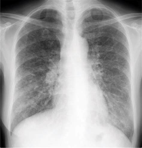 Chest Radiograph Obtained On The Day Of Admission Showing Diffuse Download Scientific Diagram