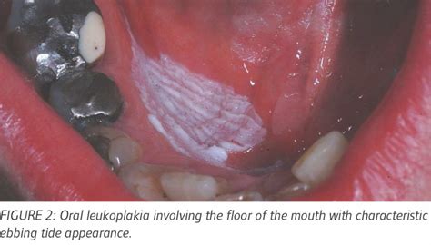 Oral Leukoplakia An Update For Dental Practitioners Published In