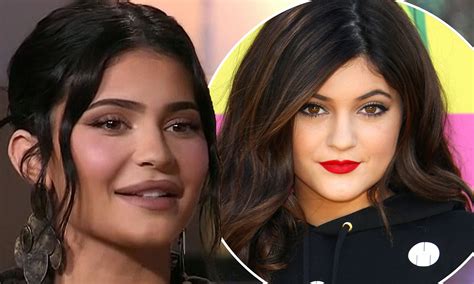 Kylie Jenner Lip Injection