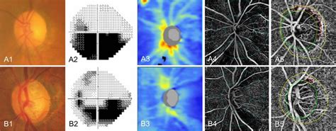 Representative Cases Of Nonarteritic Anterior Ischemic Optic Neuropathy Download Scientific