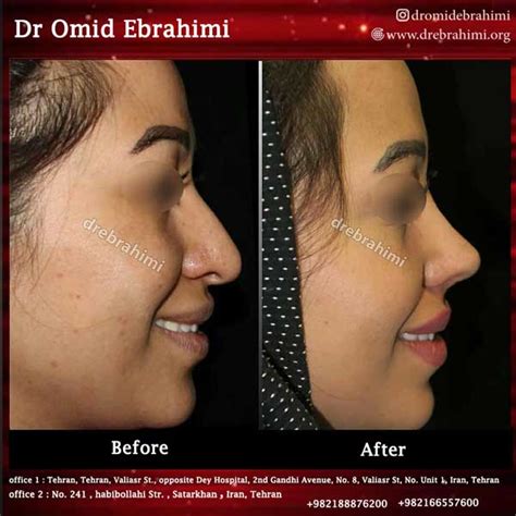 The Best Nose Surgeon In Tehran Nose Surgery Dr Omid Ebrahimi