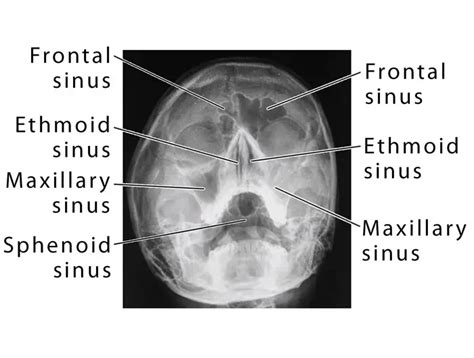 Paranasal Sinus: Definition, Location, Anatomy, Function, Picture