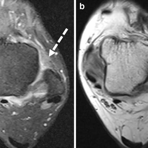 Anterolateral Impingement In An 18 Year Old Man With Complex Ankle