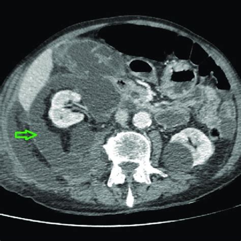 CT Scan Of The Abdomen Showing The Extension Of The Retroperitoneal