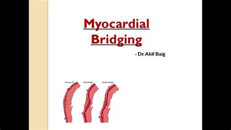 MYOCARDIAL BRIDGING Dr Akif Baig YouTube