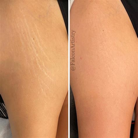 Permanent Makeup Stretch Marks Before And After Saubhaya Makeup