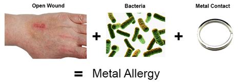 The Hidden Cause Of Nickel Metal Allergy Revealed Pyro Energen