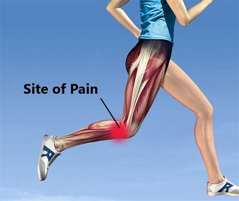 Iliotibial Band Syndrome Knee