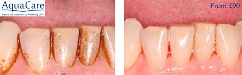 Teeth Stain Removal in Cornwall | Pain free Dentist near me | Wadebridge