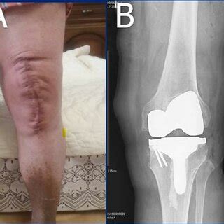 The surgical wound healed without any complication (A); the follow-up ...