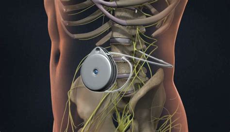 Understanding The Procedure Of Intrathecal Drug Pump Implant Charlton