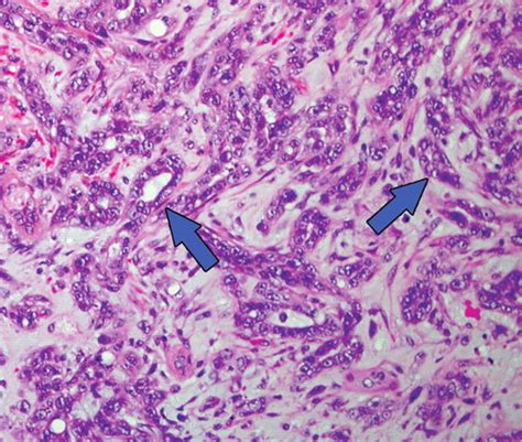 Renal Cell Carcinoma Histology