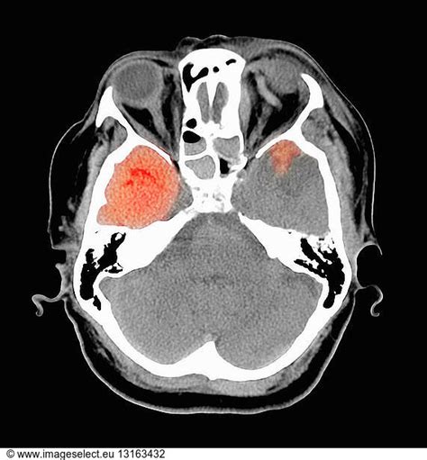 CT Scan Of Head Showing Acute Subdural Hematoma CT Scan Of Head Showing