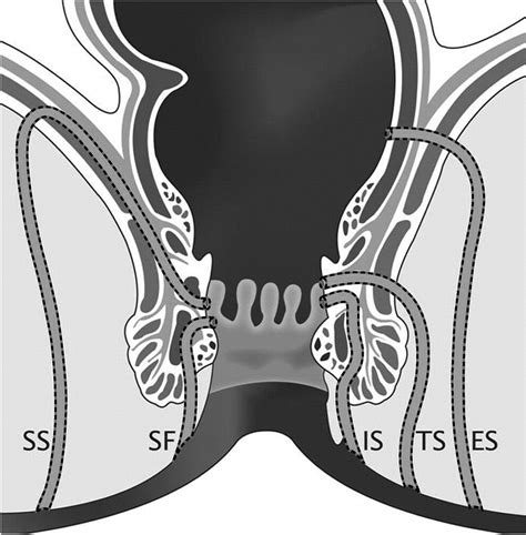 Imaging Of Perianal Fistulas Clinical Gastroenterology And Hepatology