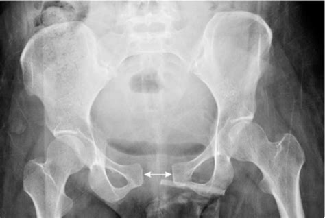 Figure 1 From Postpartum Symphysis Pubis Diastasis Semantic Scholar