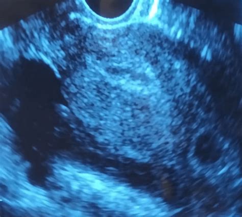 Transvaginal Two Dimensional Ultrasonography Scan In Transverse View Download Scientific