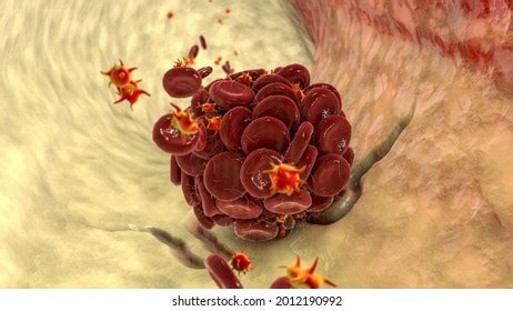 173 Damaged Erythrocytes Images Stock Photos Vectors Shutterstock